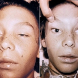 Двоение в глазах через сутки после приёма некачественной пищи - срочно 03!