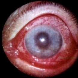 Боль в глазах в сочетании с головной болью