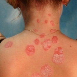 Через месяц после незащищённого полового акта плотное безболезненное образование в области гениталийна