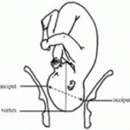 Чем грозят роды у женщин с узким тазом?