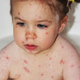 Почему у ребёнка высыпания по всему телу и сильный зуд?