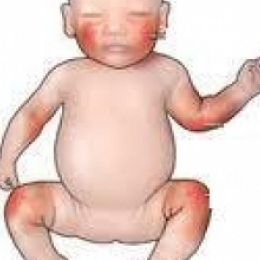 С чем может быть связано покраснение кожи у ребёнка?