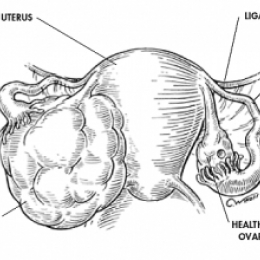 Если в крови обнаружен высокий уровень СА-125