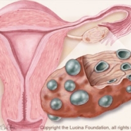 Почему я прибавила в весе, стали реже месячные, появилось волосы на лице?