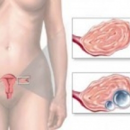 Резкая боль в животе после овуляции или перед менструацией