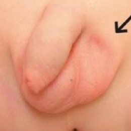 У ребёнка одна половина мошонки пустая