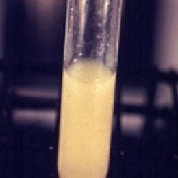 Боль, жжение при мочеиспускании. Что будет, если не обращать внимание?