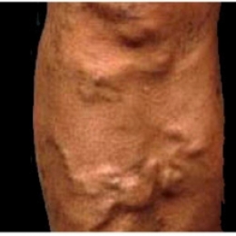 Расширенные вены и тяжесть в ногах