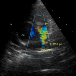 Баталов проток - что это такое и зачем он должен зарастать?
