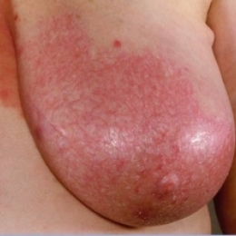 Чем грозит неправильный уход за сосками во время кормления грудью?