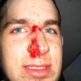 После удара нос болит и опух - повод обратиться к травматологу!