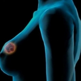 При ощупывании уплотнение в груди - повод немедленно обратиться к врачу!