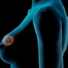 Уплотнение в наружной верхней четверти молочной железы