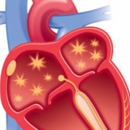 Ощущение сердцебиения, приводящее к головокружению и потере сознания