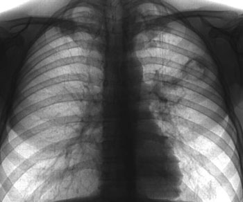 Инфильтративный туберкулез