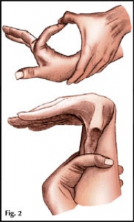 Синдром Марфана