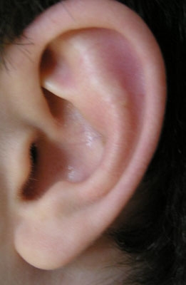 Острый неврит слуховых нервов