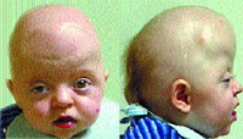 Синдром Апера