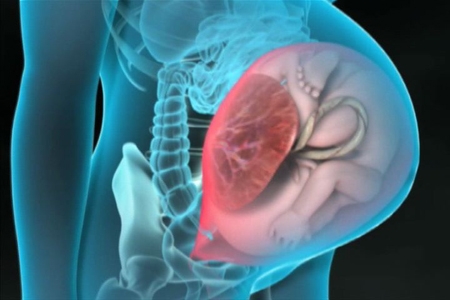 Разрыв матки