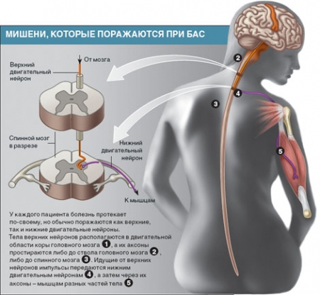 Боковой амиотрофический склероз (БАС)