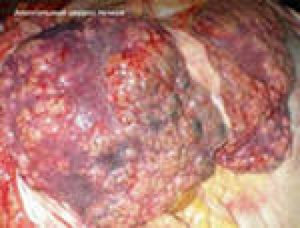 Алкогольный цирроз печени