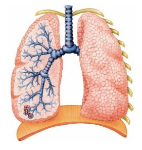 Хронический бронхит
