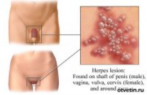 Генитальный герпес