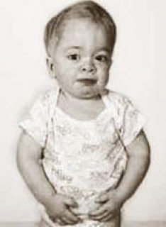 Амавротическая детская ранняя идиотия