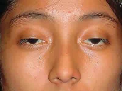 Лагофтальм