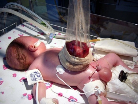 Омфалоцеле