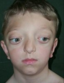 Синдром Крузона