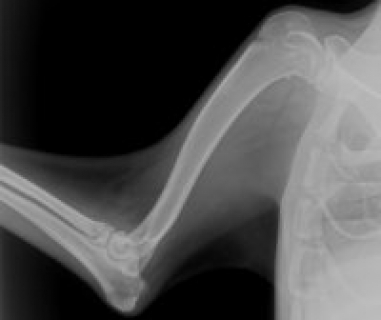 Алгонейродистрофия