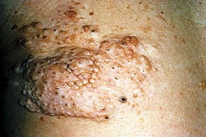 Болезнь Бурневилля - Прингла