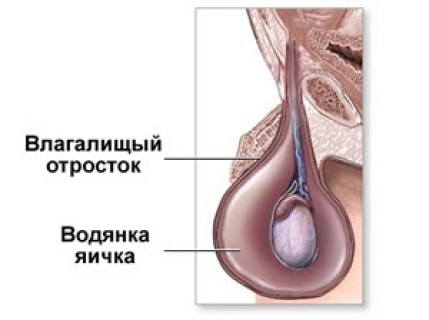 Водянка яичка (Гидроцеле)