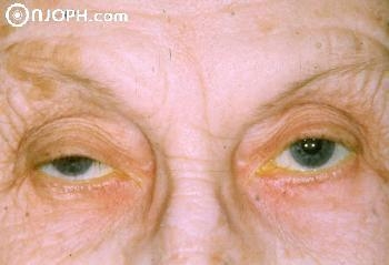 Апоневротической птоз (опущение верхнего века)