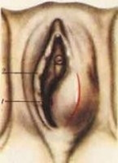 Бартолинит