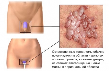 Аногенитальный кондиломатоз