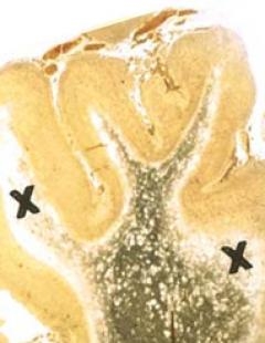 Болезнь Канаван