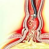 Варикозное расширение вен пищевода с кровотечением