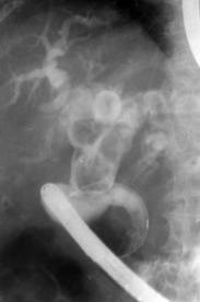 Постхолецистэктомический синдром