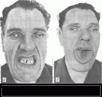 Акромегалия