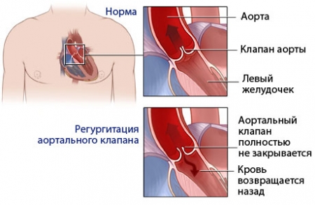Недостаточность аортального клапана