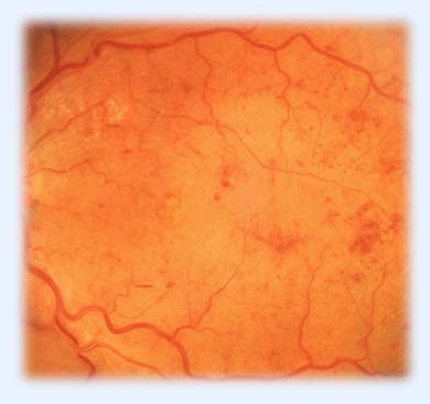 Ретинопатия диабетическая