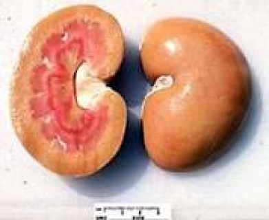 Амилоидоз почек