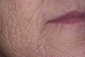 Атрофические изменения кожи