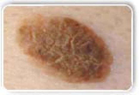 Папилломатоз