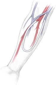 Артериовенозная фистула