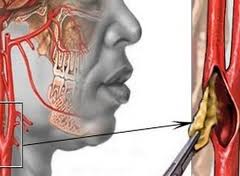 Атеросклероз сосудов головного мозга
