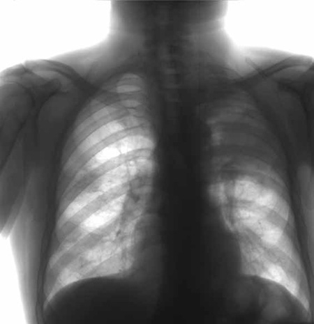 Кавернозный туберкулез