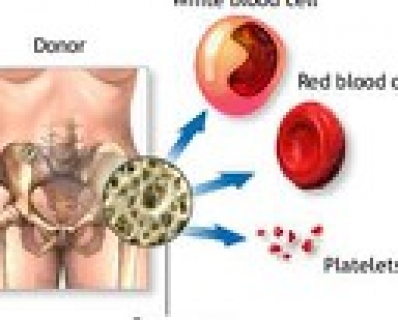 Апластическая анемия